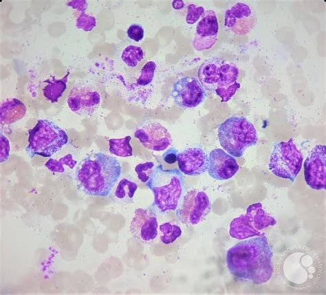 Bone marrow aspirate