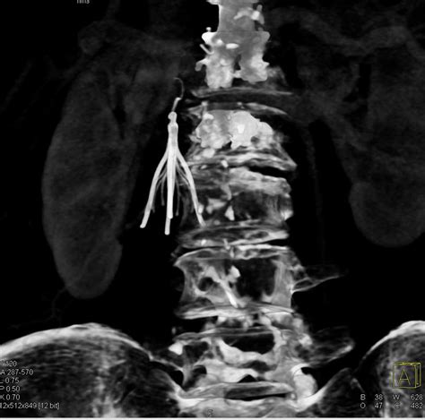 3D of IVC Filter - Vascular Case Studies - CTisus CT Scanning