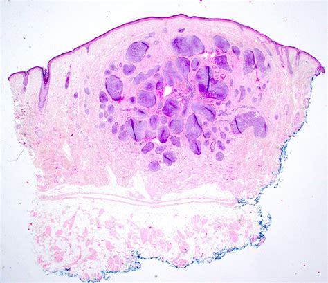 Pathology Outlines - Trichoepithelioma / trichoblastoma