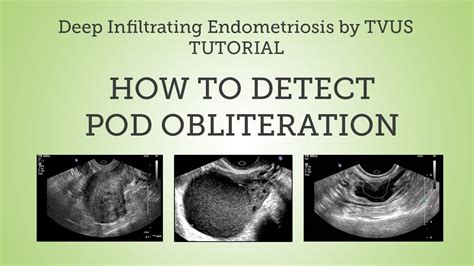 Pouch of Douglas Obliteration Detection by TVUS Tutorial - YouTube