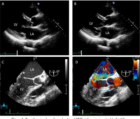 Figure 1 from Severe Mitral Regurgitation As a Result of Rupture of ...