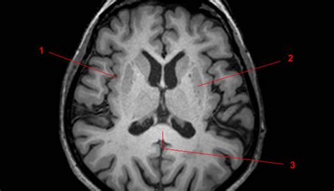 MRI of the White and Gray Matter in the Brain - W-Radiology