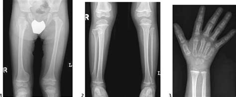 114 Multiple Hereditary Exostoses | Radiology Key