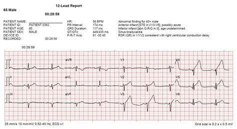 LAD Occlusion Often Presents Without Reciprocal Changes - ECG Medical Training