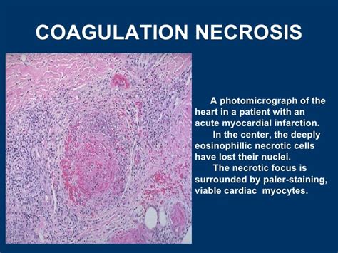 General pathology lecture 3 cell death or necrosis