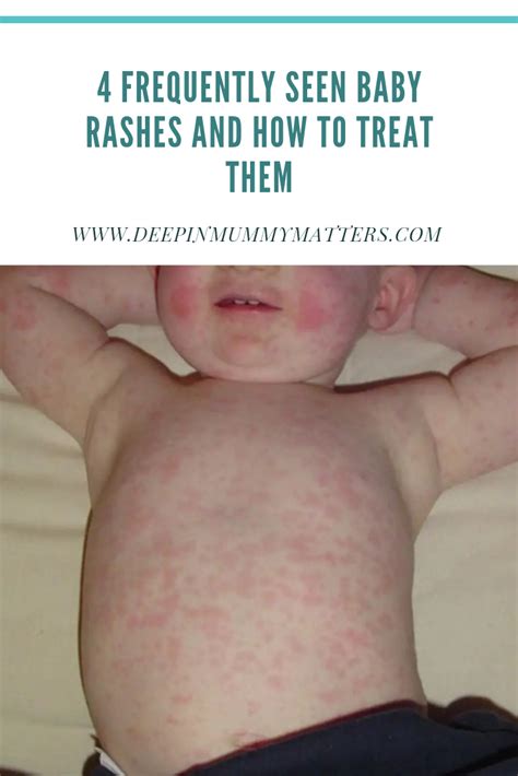 4 Frequently Seen Baby Rashes and How to Treat Them - Mummy Matters: Parenting and Lifestyle ...