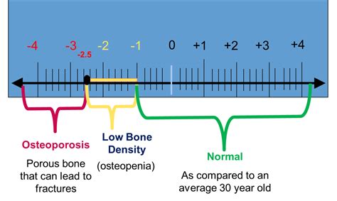 Osteoporosis and Bone Loss Can Be Reversed Naturally | HealDove