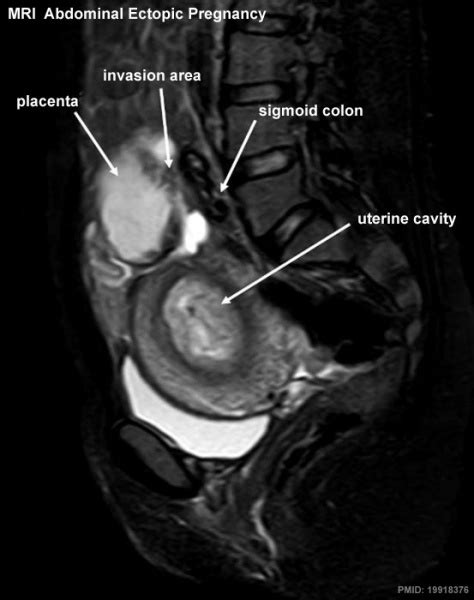 File:Abdominal ectopic pregnancy MRI.jpg - Embryology