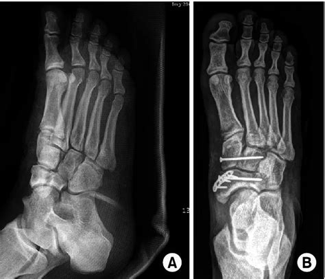 Cuneiform Fracture - Causes, Symptoms, and Treatment Options