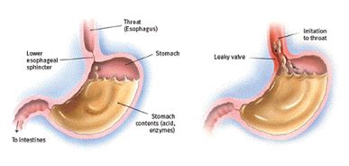 Dyspepsia Causes, Symptoms, Diagnosis and Treatment - Natural Health News