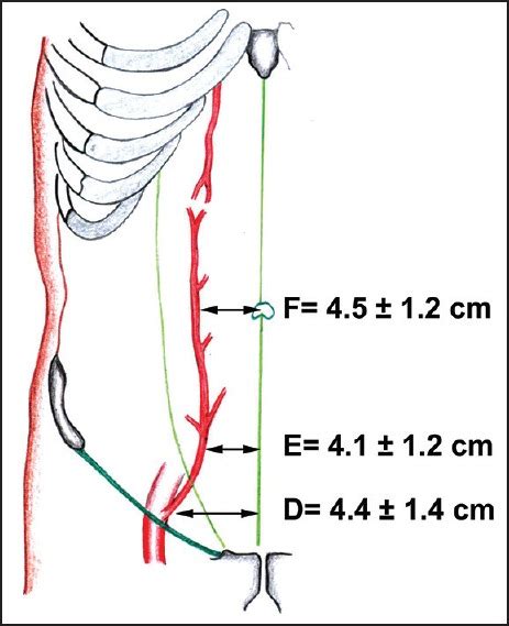 Inferior Epigastric Artery