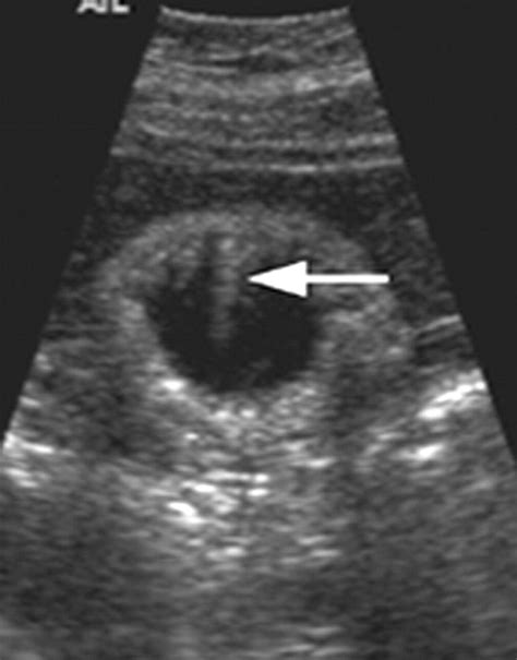 Adenomyomatosis of the Gallbladder | RadioGraphics