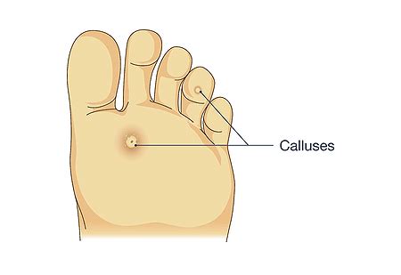 Callus Cure Foot Repair – Inland Finder