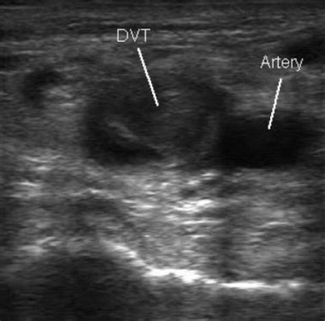 Deep Venous Thrombosis (DVT) – Core EM