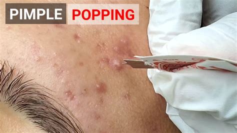 PIMPLE POPPING VIDEO - YouTube