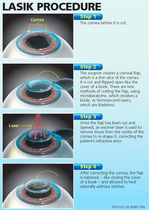 The side effects of LASIK. What you need to know | Plano Eye Health