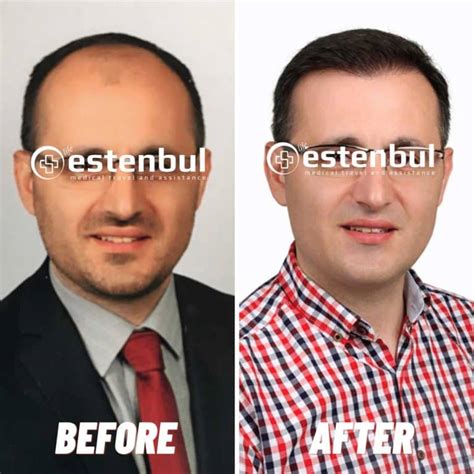 Hair Transplant Turkey Before After 2024 | Estenbul Health