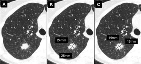 Recommendations for Measuring Pulmonary Nodules at CT: A Statement from the Fleischner Society ...