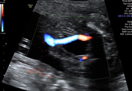 Umbilical Artery Ultrasound