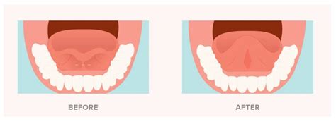 Exercises After Lip And Tongue Tie Release | Sitelip.org