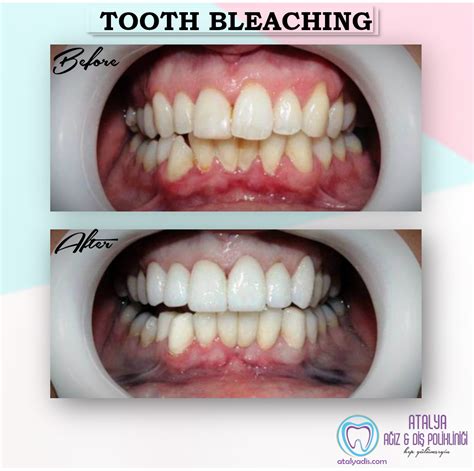 TOOTH BLEACHING (WHITENING) - Before&After | Teeth bleaching, Teeth, Bleach