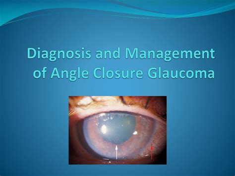 PPT - Diagnosis and Management of Angle Closure Glaucoma PowerPoint ...