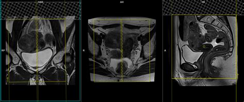 Endometriosis MRI | Endometriosis MRI Protocol and Planning