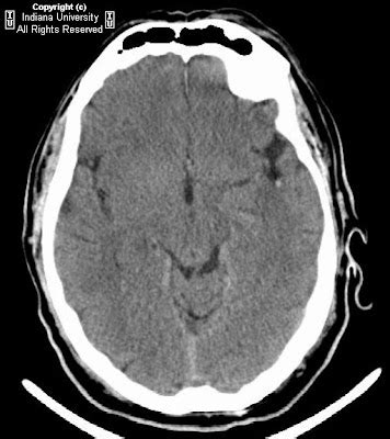 Neuroradiology On the Net: Acute left MCA stroke with thrombus seen on CT-angiogram