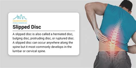 Slipped Disc Symptoms, Causes And Treatment Disc Prolapse, 49% OFF