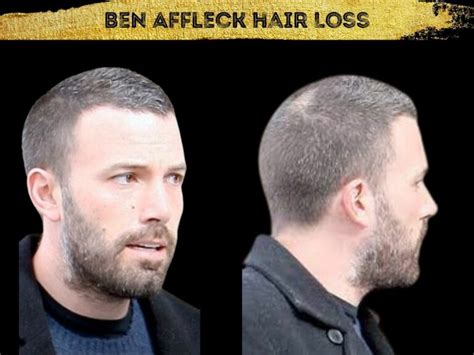 Ben Affleck Hair Transplant - Hair Loss & Technical Analysis