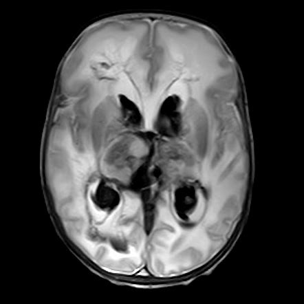 Grade IV germinal matrix hemorrhage with periventricular leukomalacia | Image | Radiopaedia.org