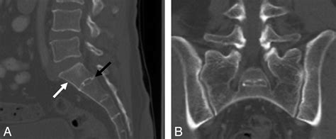 Lumbarisation