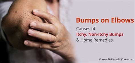 Bumps on Elbows: Causes of Itchy & Non-Itchy Bumps,Treatment Options