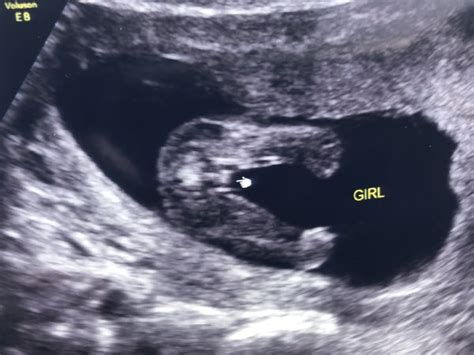 15/16 week ultrasound boy or girl?! | BabyCenter