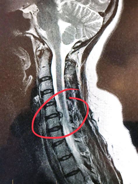 I was told I had Cervical Spinal Stenosis, but it looks more like a Herniated disk? : r/MRI