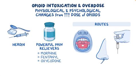 Opioid intoxication and overdose: Clinical sciences - Osmosis Video Library