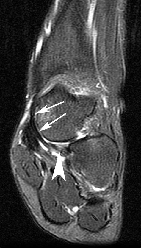 MRI of Spring Ligament Tears | AJR