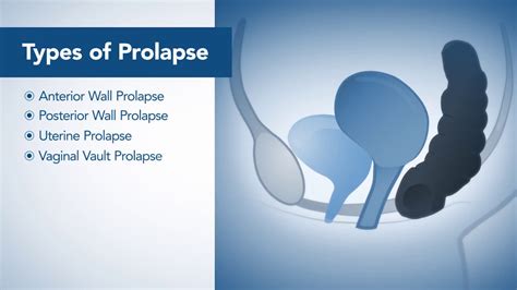 Uterine Prolapse