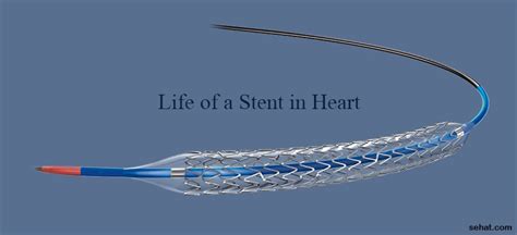 How Long Does a Heart Stent Last? |Healthy Living