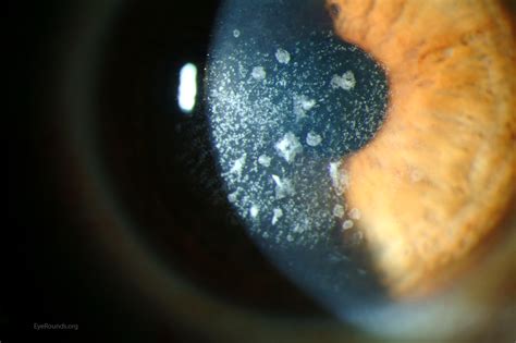 Avellino type II granular corneal dystrophy. EyeRounds.org Online Ophthalmic Atlas