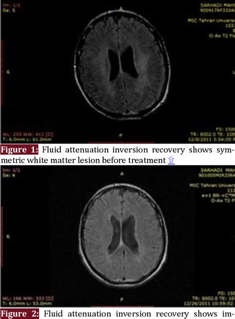 Figure 1 from Hashimoto Encephalopathy in Case of Progressive Cognitive Impairment; a Case ...