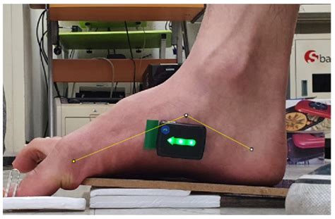 Healthcare | Free Full-Text | Effect of Peroneus Longus Muscle Release on Abductor Hallucis ...