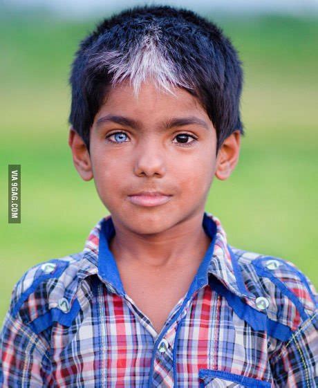 White Forelock Of Hair / Waardenburg Syndrome Wikipedia - filmesexclusivosbr