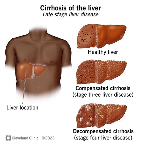 Understanding Cirrhosis: Causes, Symptoms, and Treatment - Ask The Nurse Expert