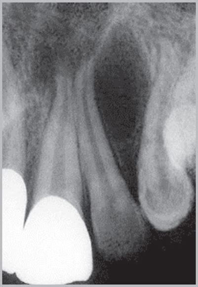 Globulomaxillary Cyst