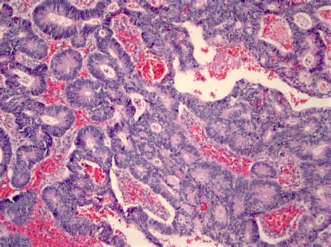 Tubular Adenoma Histology