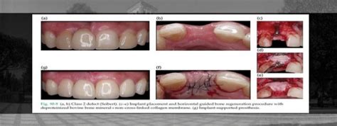 Ridge Augmentation Procedures