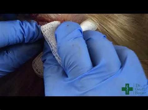 Removal of 2 Pilar Cysts on top of one another - YouTube | Cysts, Pilar, One