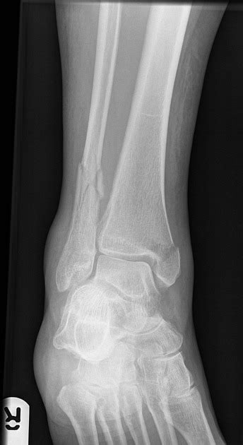 Tibia And Fibula Fracture