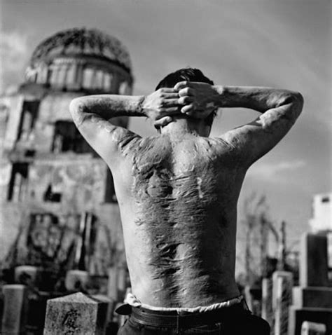 This is the back of a survivor of the Hiroshima nuclear explosion via ...